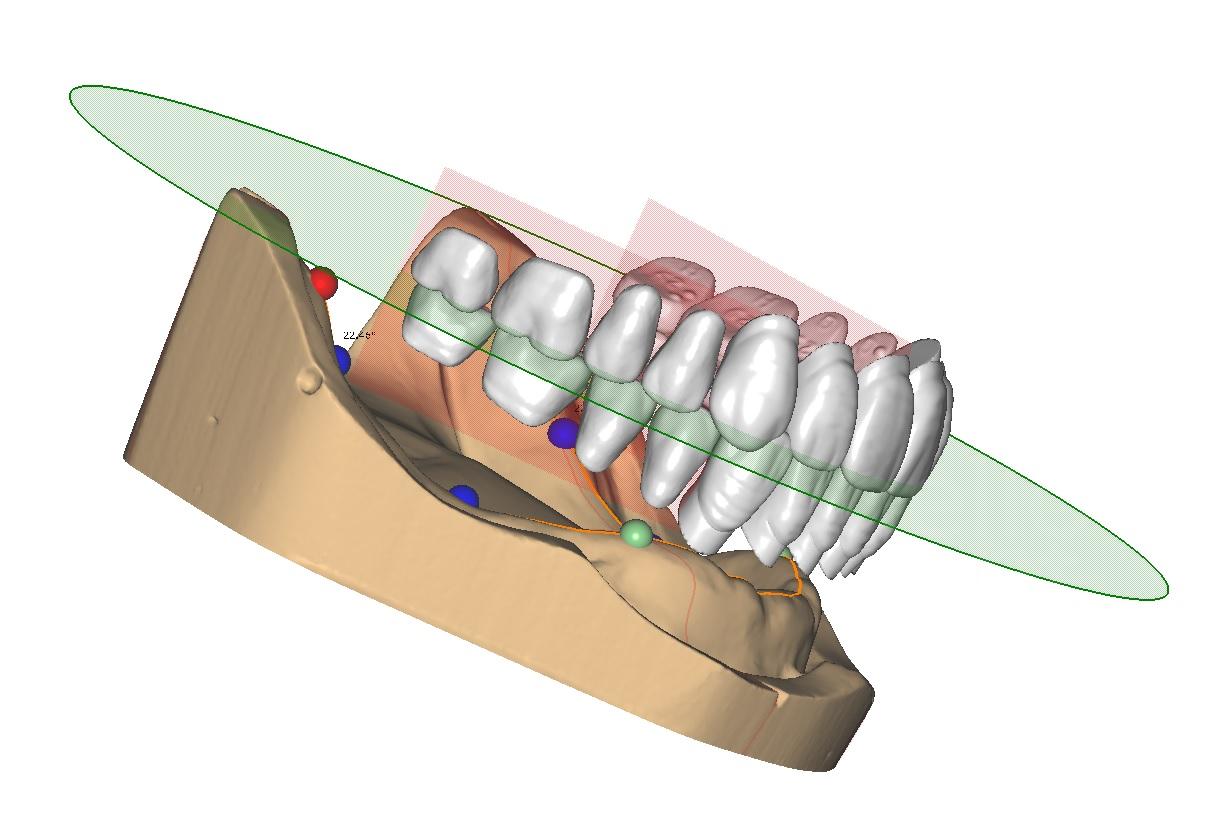 PRÓTESIS COMPLETAS EN CAD-CAM – HelloDent