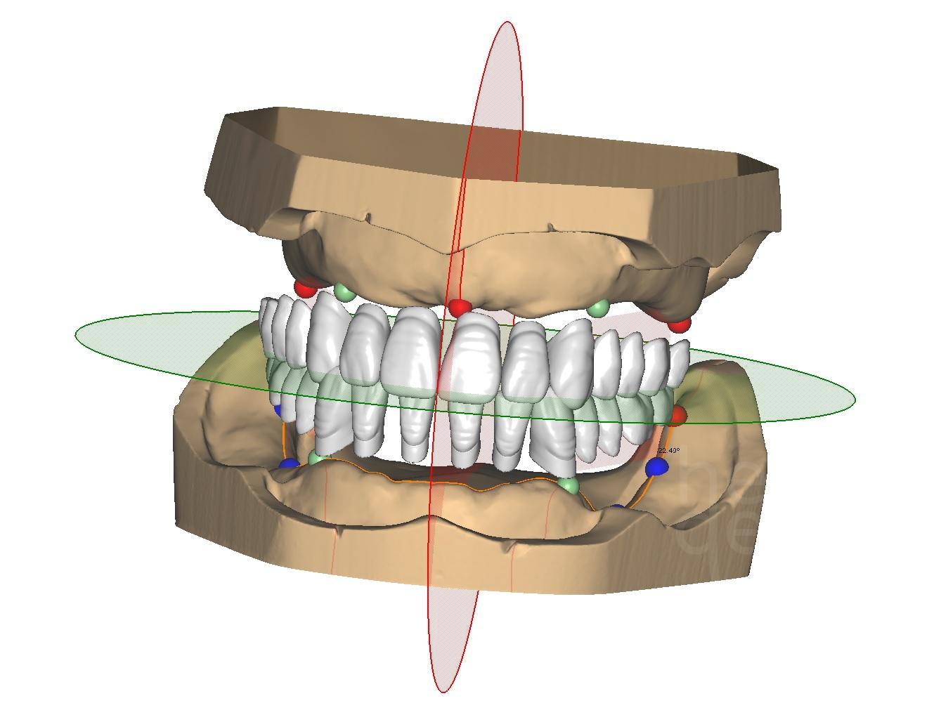 PRÓTESIS COMPLETAS EN CAD-CAM – HelloDent