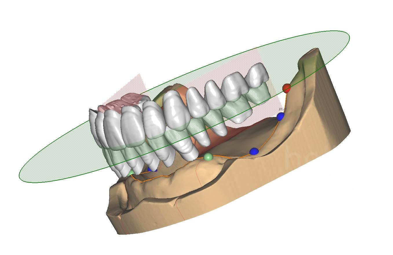 PRÓTESIS COMPLETAS EN CAD-CAM – HelloDent